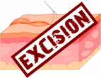 Odstranění tetování - excision