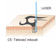 Metodika odstranění tetování