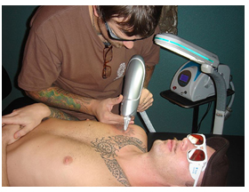 Odstranění tetování laserem